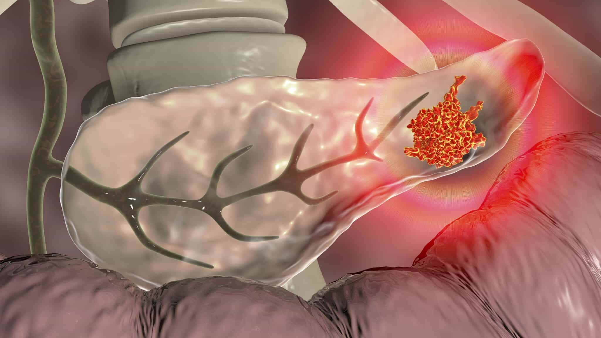 cancer-de-pancreas