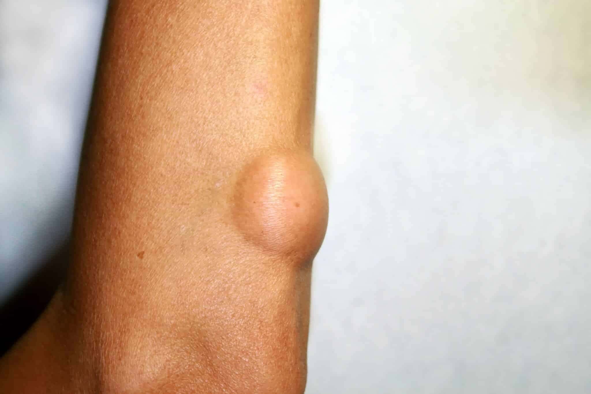 lipoma