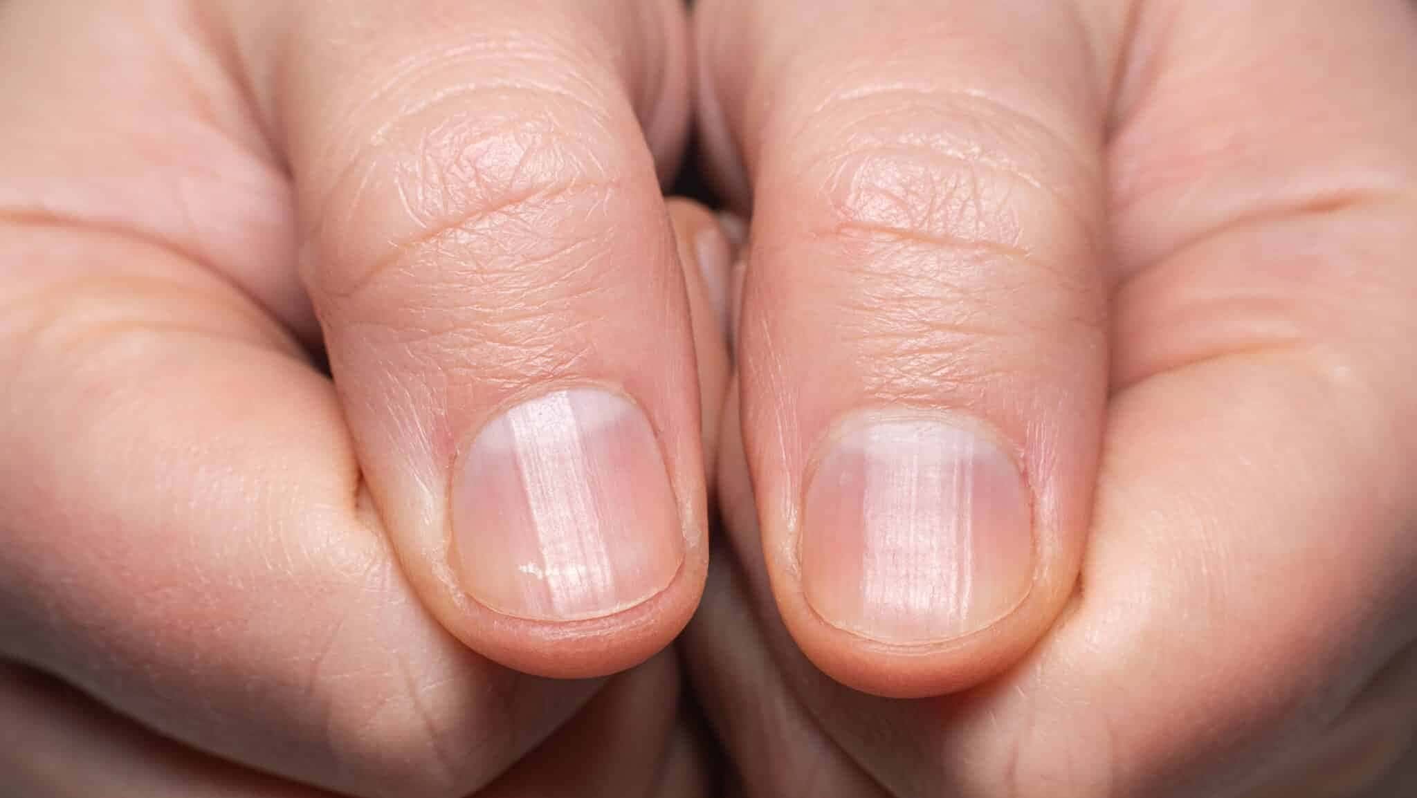 unhas-estriadas-e1752516773662