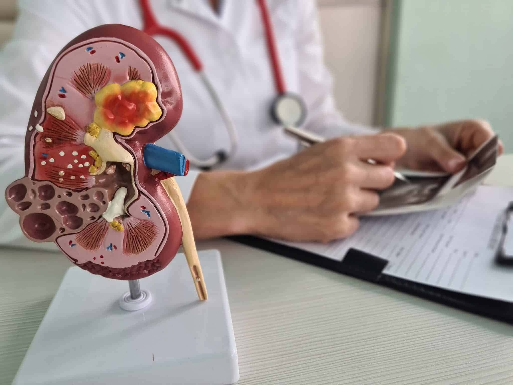 cancer-renal