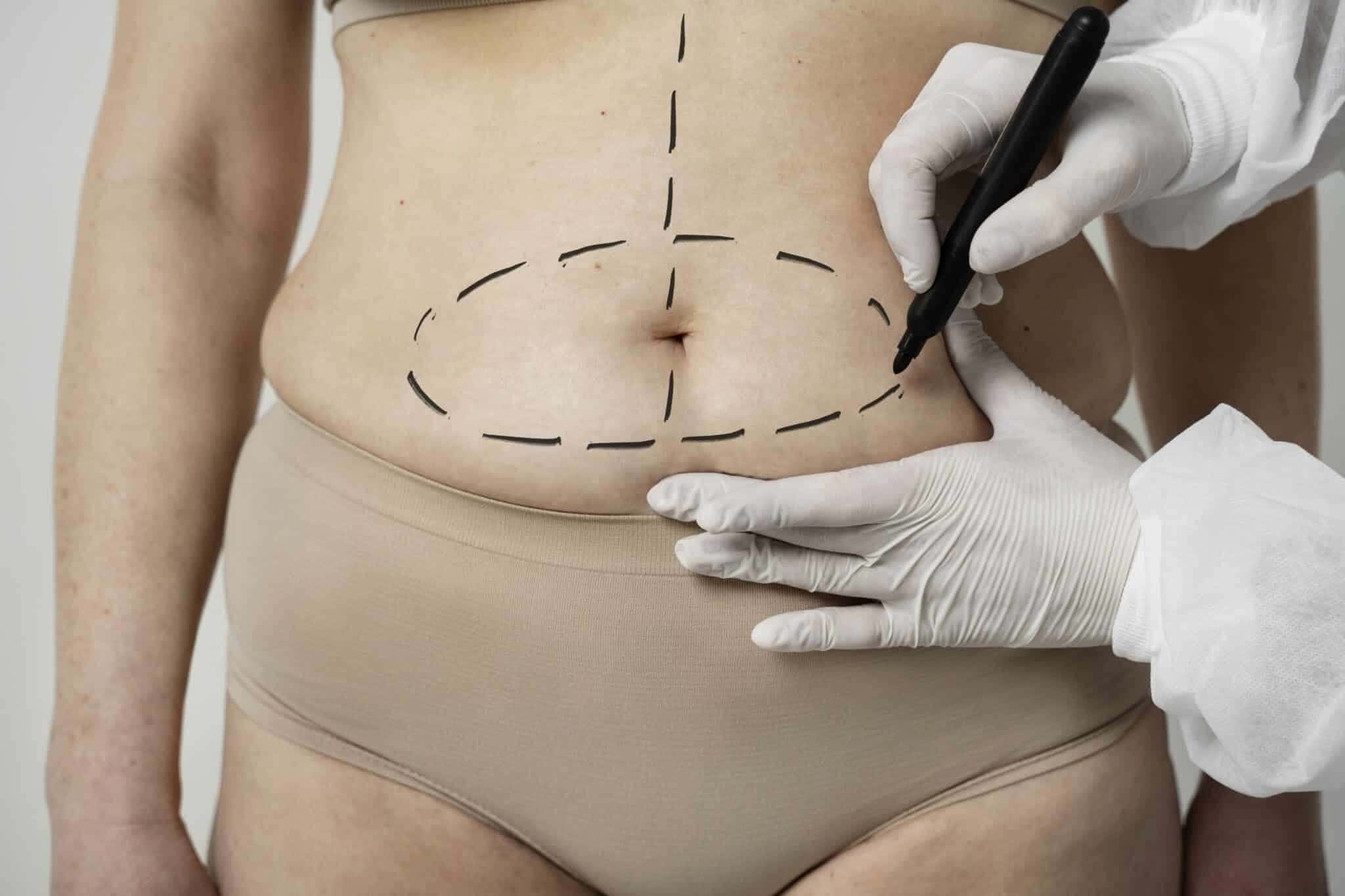 hidrolipo