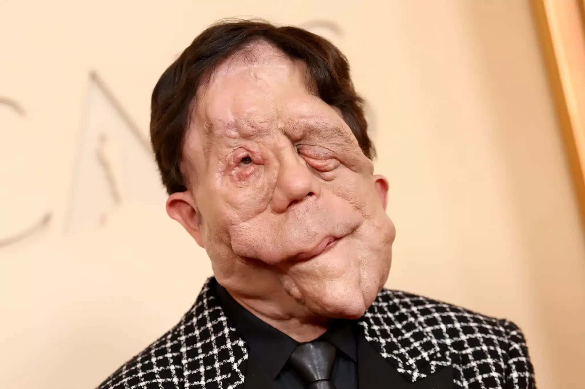 Adam-Pearson