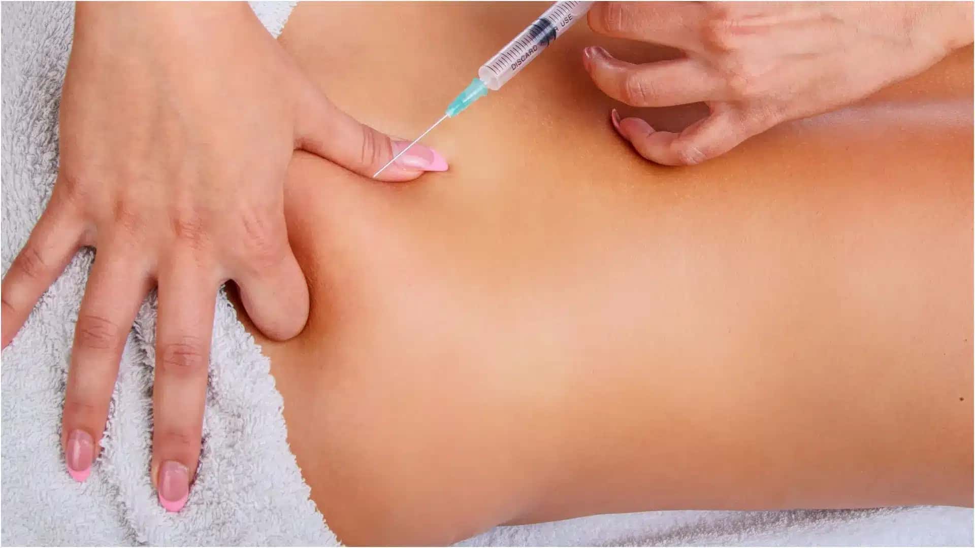 injecao-pmma-procedimento-estetico