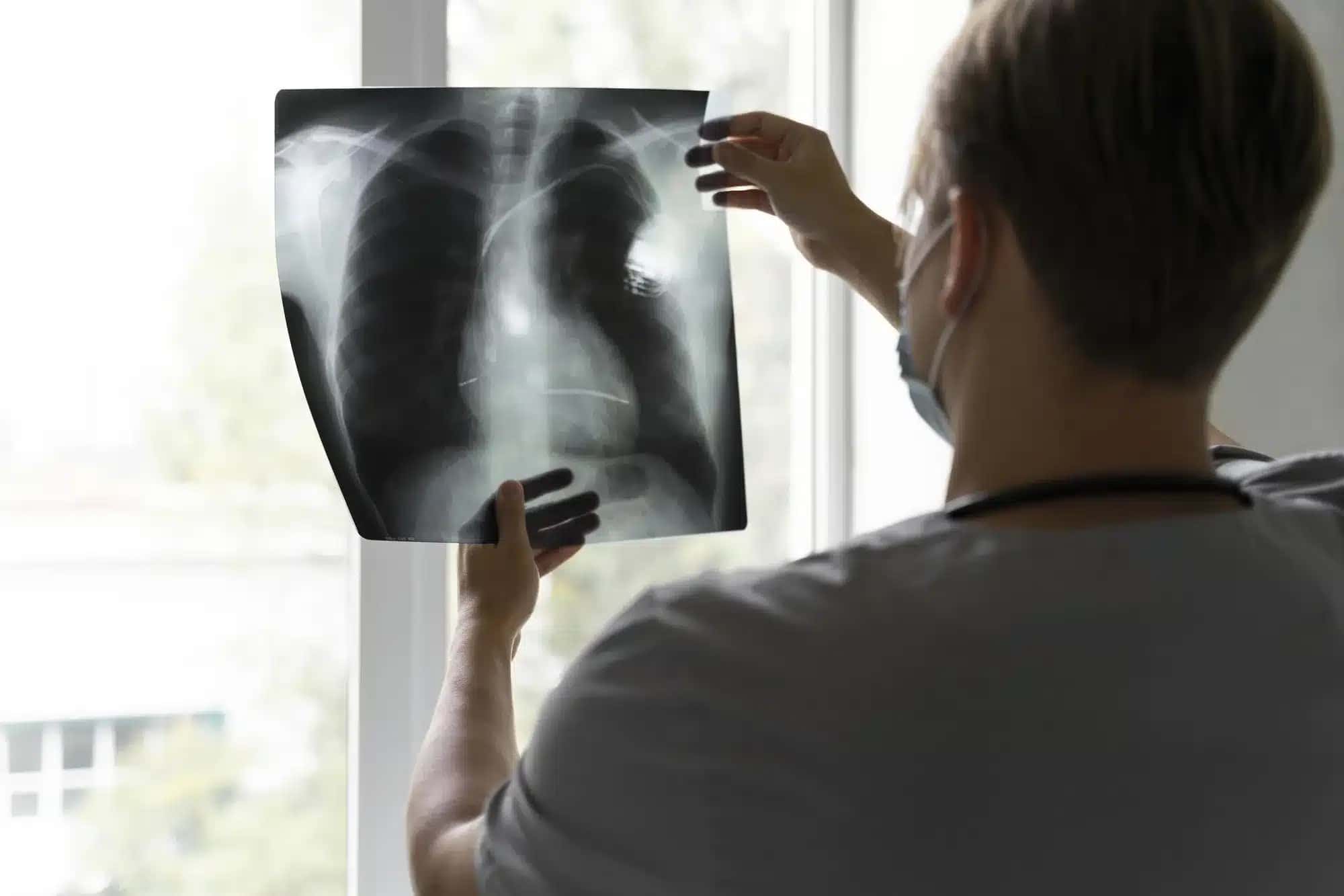 Após a progressão ao tratamento com inibidores de EGFR e quimioterapia à base de platina, as opções terapêuticas disponíveis apresentam benefício clínico limitado, o que caracteriza uma importante necessidade médica não atendida