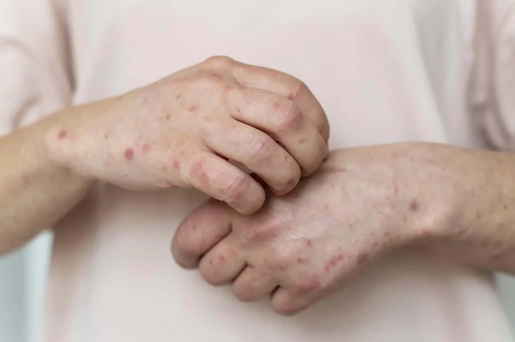 Sarampo pode ser prevenido com vacinação