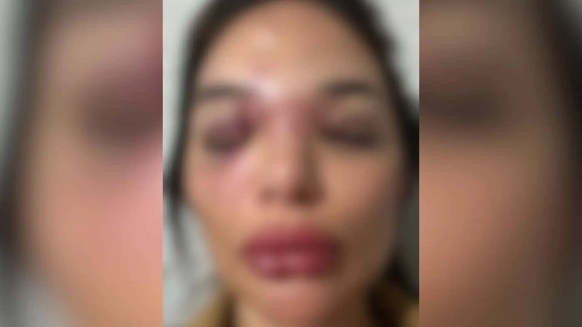 Dentista é agredida por marido e fica com o rosto desfigurado