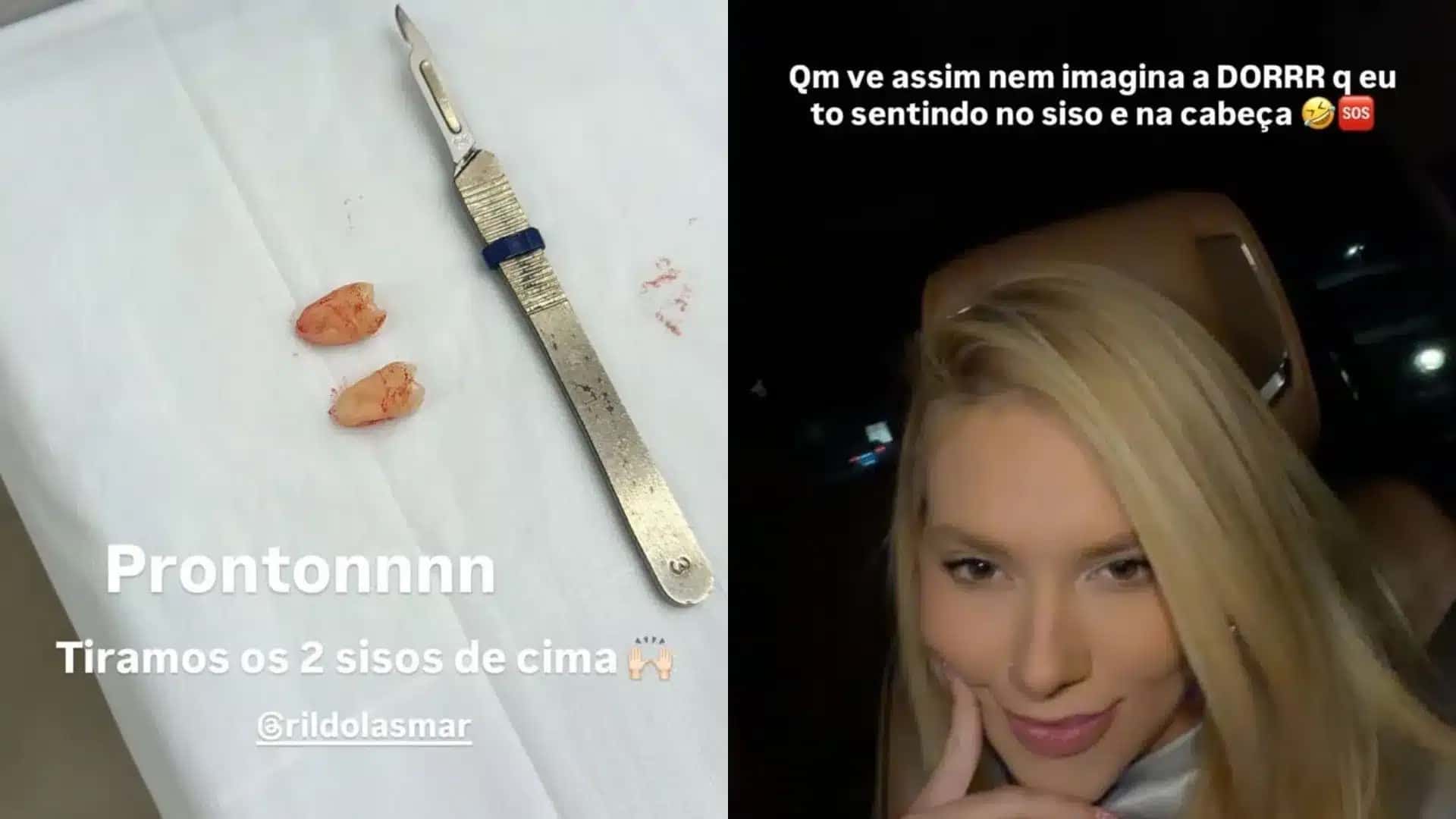 A influenciadora Virginia Fonseca, relatou, nesta terça-feira (29), que passou por uma cirurgia para retirar dois sisos. Segundo a empresária, ela estava sentindo fortes dores antes do procedimento