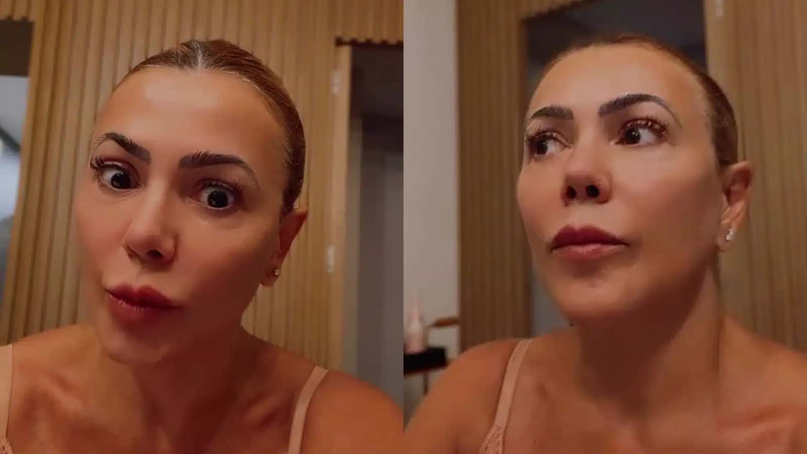 Ex-BBB revelou ter descoberto cisto no crânio
