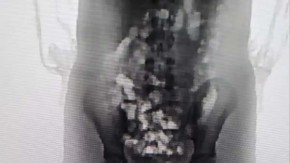 Caso ocorreu em Chapecó, Santa Catarina.