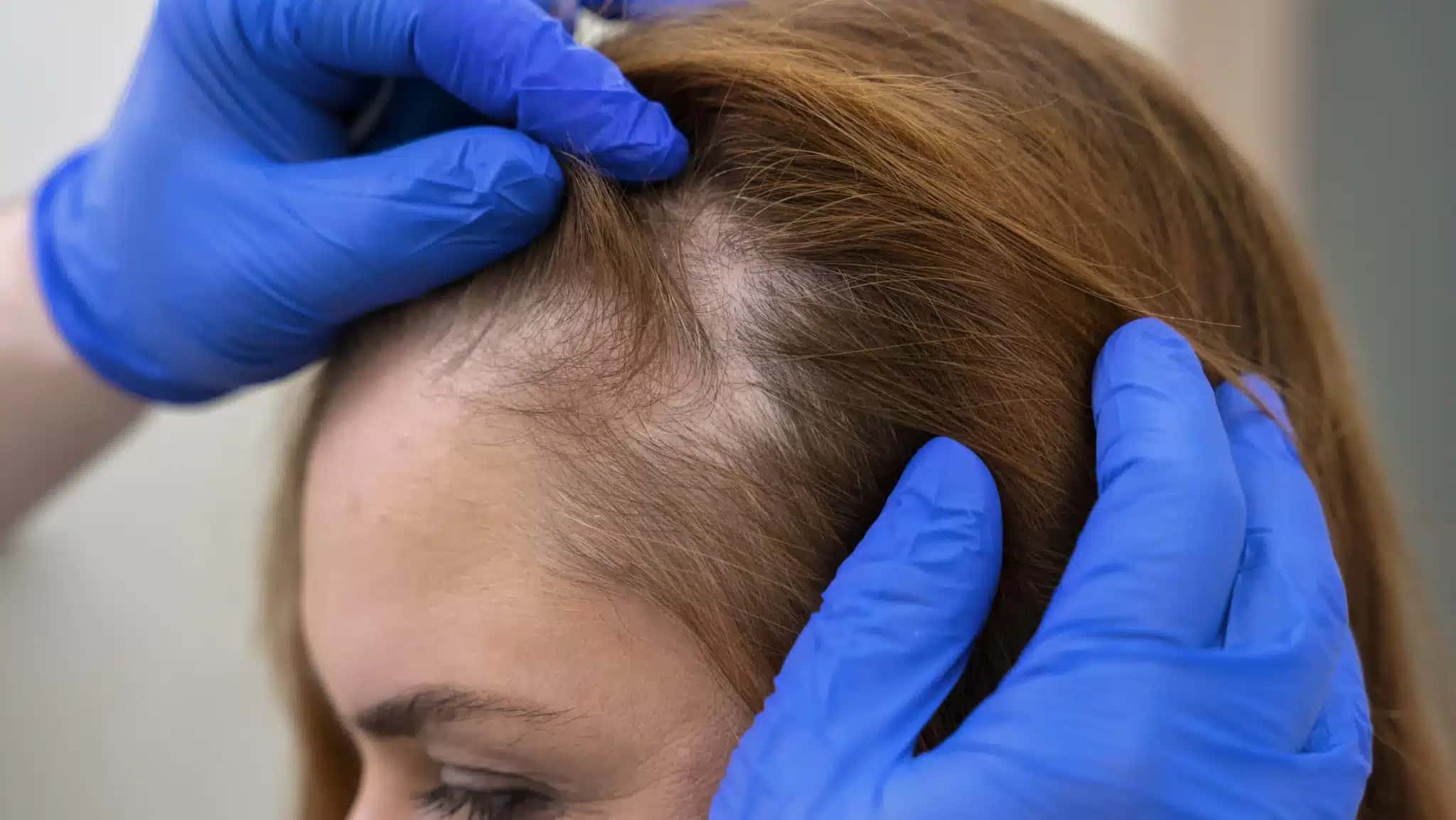 Alopecia areata é uma condição autoimune crônica e inflamatória que vai além da questão estética.