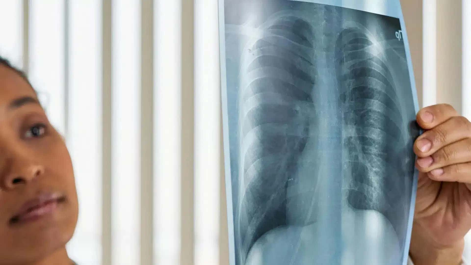 Diagnóstico de câncer no pulmão deve ocorrer de forma mais rápida no SUS