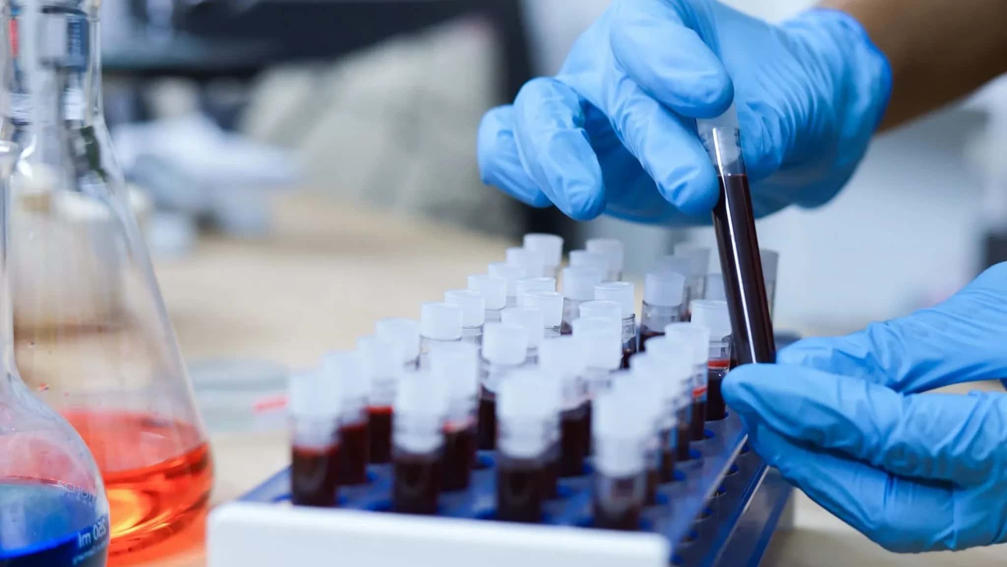 Novo teste poderá ajudar médicos a decidirem quais pacientes devem receber o tratamento padrão para o câncer de próstata.
