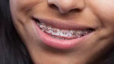 Aparelho Ortodôntico na Infância: Descubra Como Manter os Dentes Alinhados Após o Tratamento!