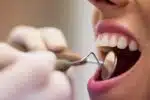 Cárie dental: mitos e fatos que todo paciente deve conhecer