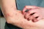 Novo tratamento diminui em 63&percnt; o prurido em pacientes com dermatose