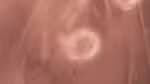 Microplástico detectado pela primeira vez no cordão umbilical no Brasil