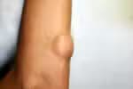 Quando um nódulo sob a pele é motivo de preocupação, entenda o que são lipomas