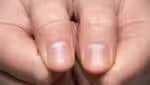Unhas estriadas: o que pode ser e como tratá-las