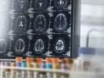 O lítio pode ser fundamental para entender os segredos do Alzheimer, aponta pesquisa