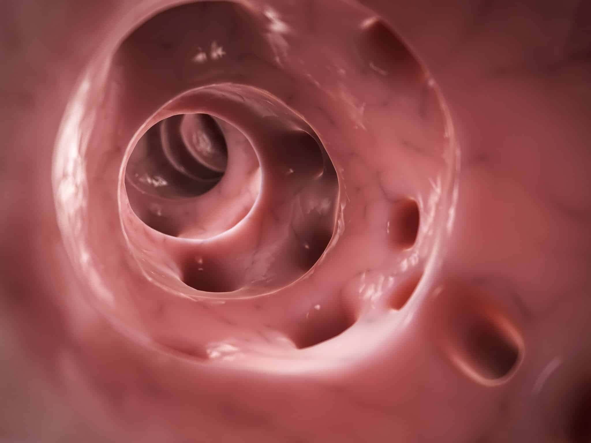 intestino-diverticulite