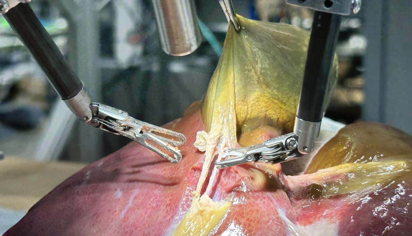 robot-surgery-procedure-e1752800997578