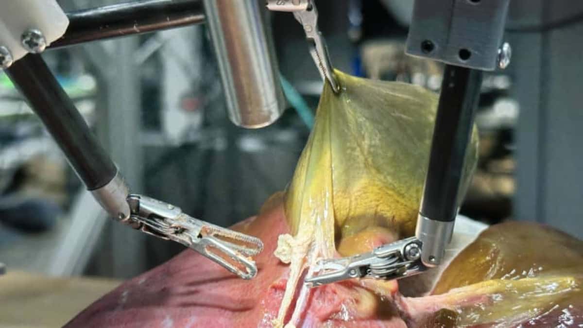 robot-surgery-procedure_john-hopkins-848×477-1