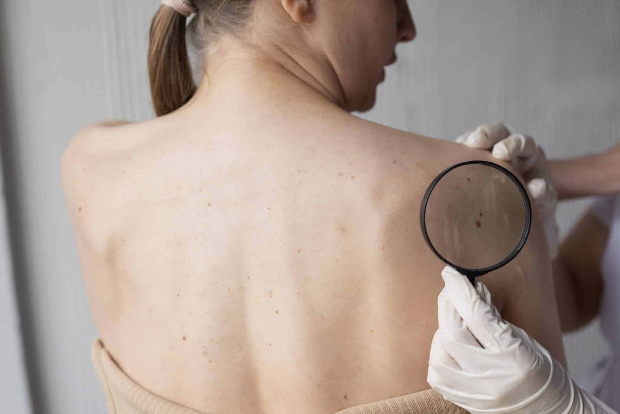 medica-diagnosticando-um-melanoma-no-corpo-de-uma-paciente-do-sexo-feminino