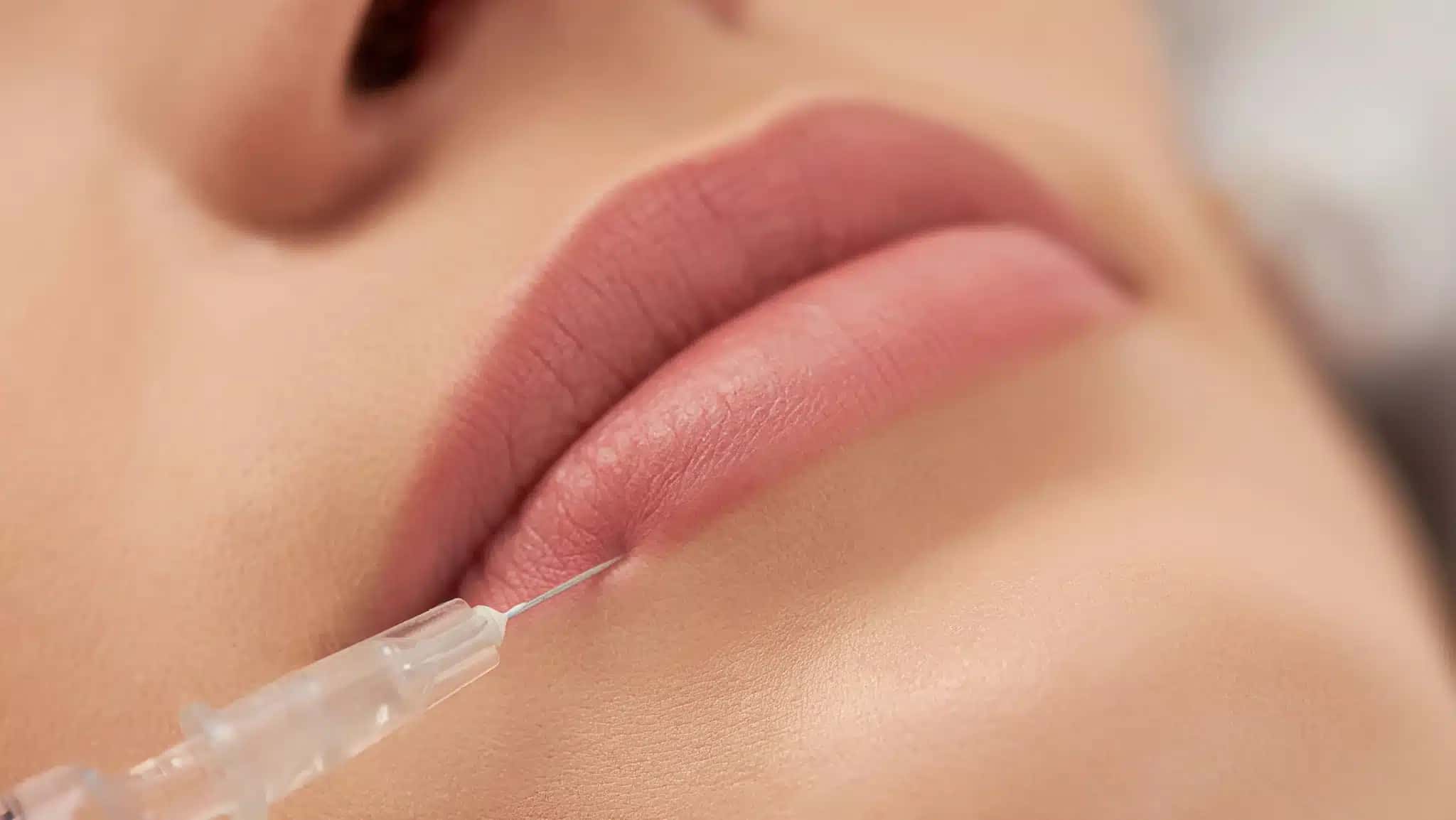 PMMA-procedimento-estetico-preenchimento-labial-e1780348182883
