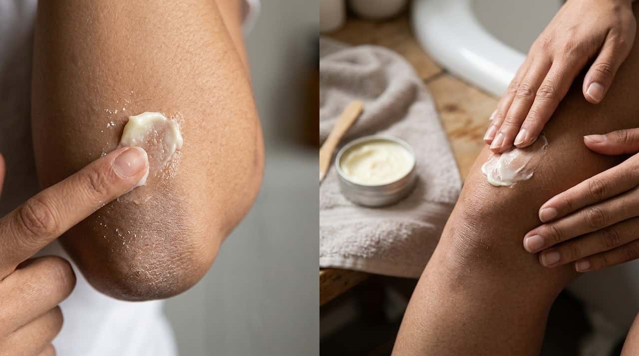 Essas áreas do corpo sofrem atrito frequente com roupas, móveis e superfícies.