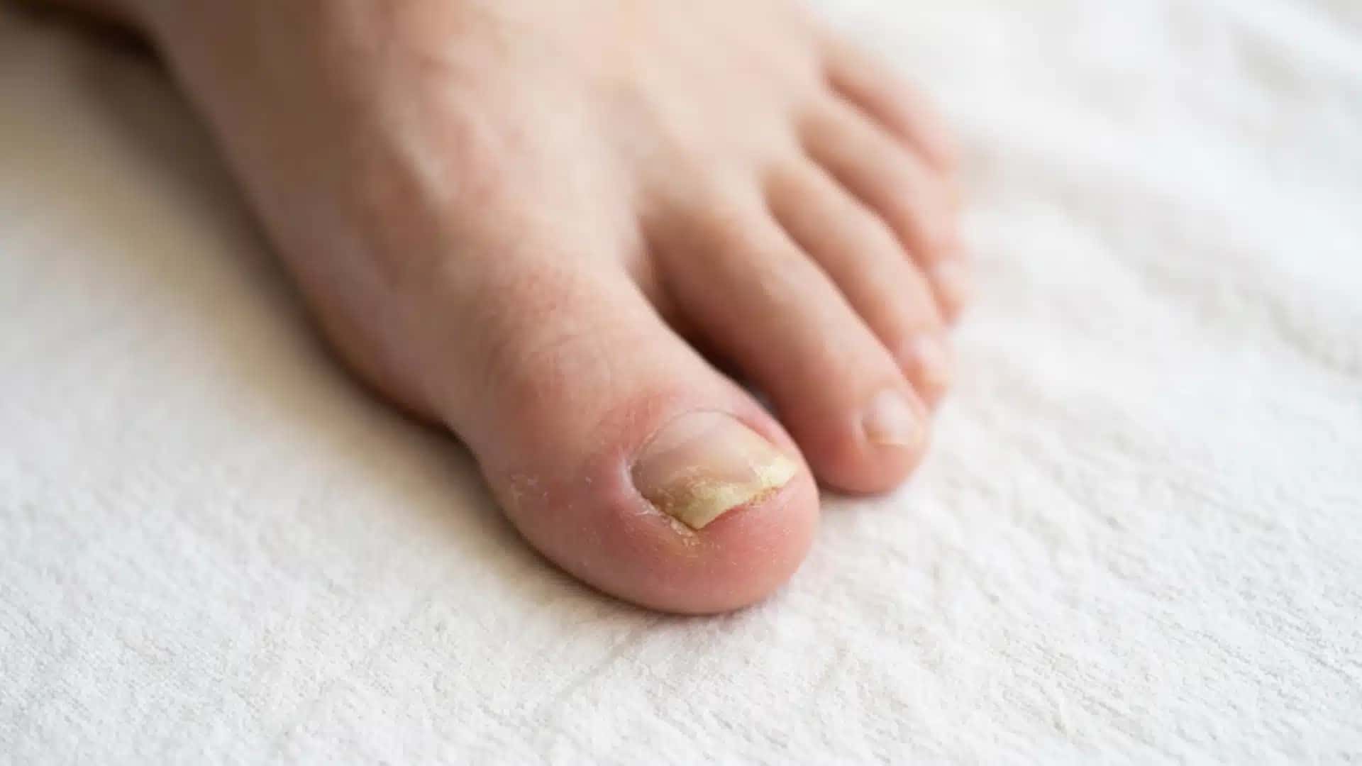 Como acabar com micose de unha Biólogo revela receita caseira simples