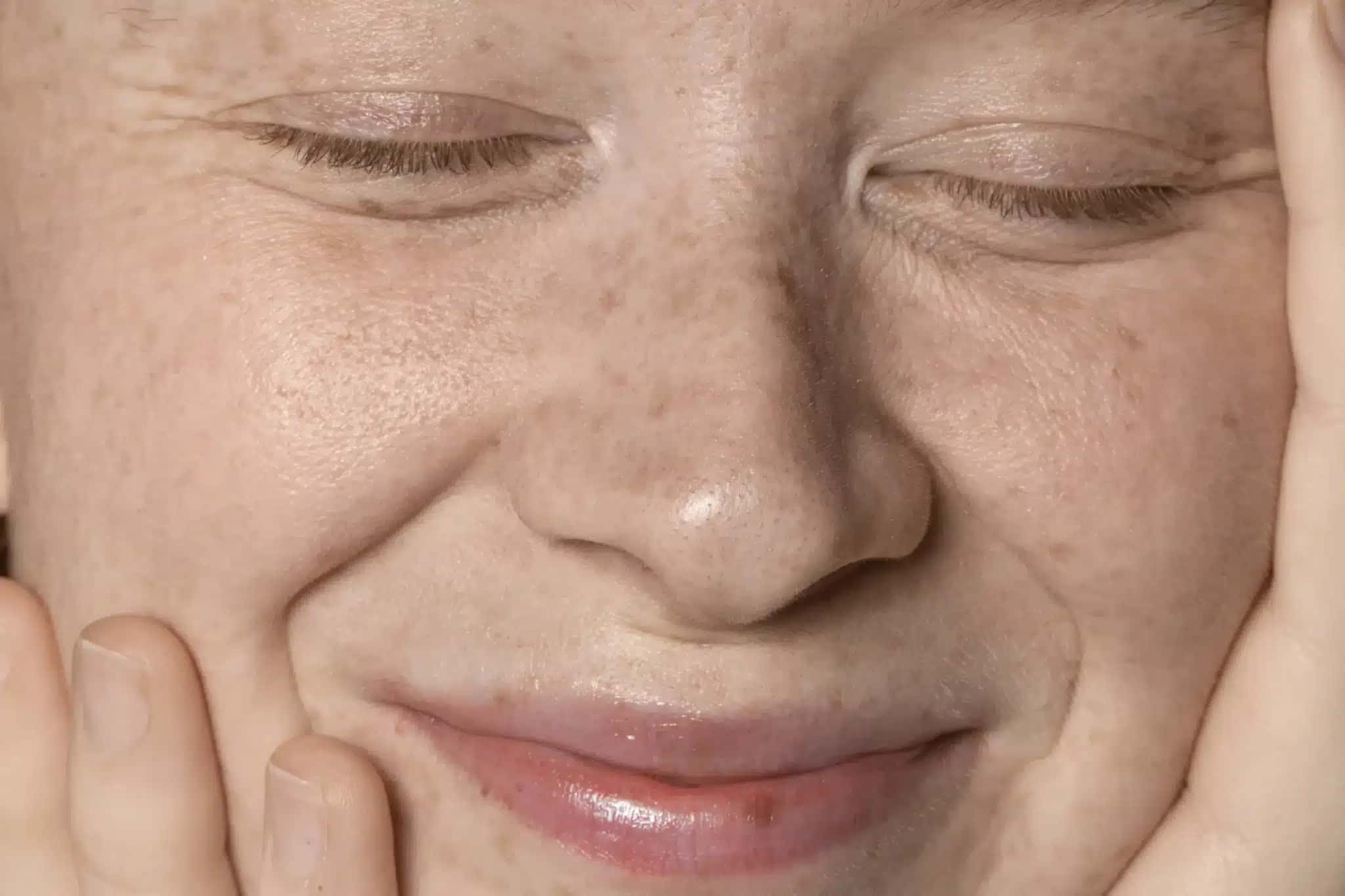 Mulheres estão mais suscetíveis ao diagnóstico de melasma