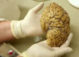 Cientistas criam mapa genético do cérebro em busca de tratamentos para Alzheimer e Parkinson