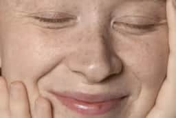 Melasma: os ativos com respaldo científico para clarear as manchas