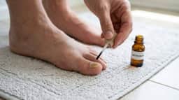 Esmalte antifúngico serve para toda micose nas unhas dos pés? Quando ele ajuda e quando não